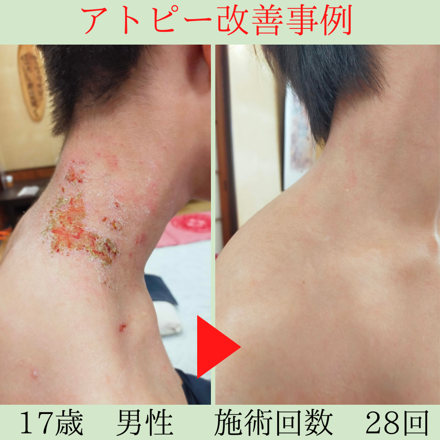 幼少期からのアトピーを克服|薬を手放し「自分の力」で改善できました。 袋井市 17歳 H君