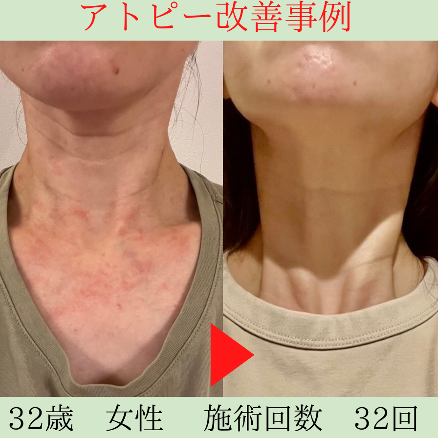 食事療法だけでは改善されなかったアトピーが、整体を取り入れることで改善されました。 浜松市 32歳 Sさん