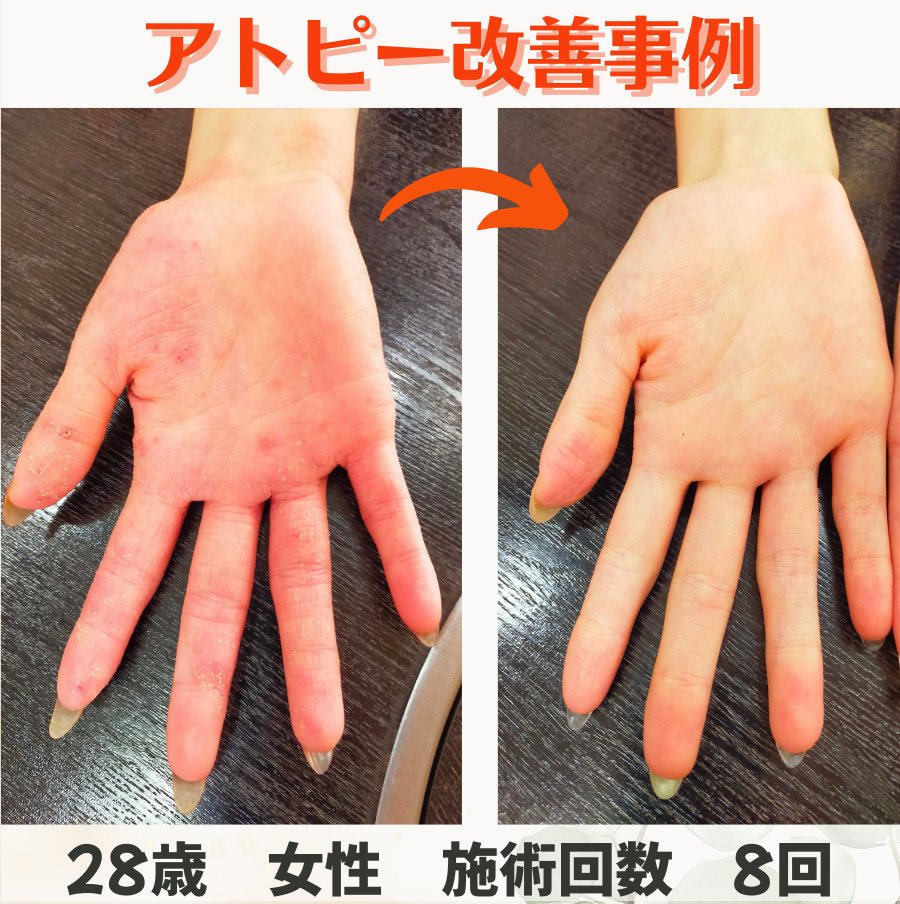 病院でも改善しなかった産後の発疹が、約1ヶ月半で変化を実感!!